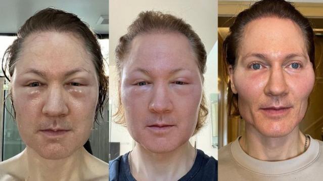 "죽은 사람 지방으로 젊음 유지"..할리우드서 유행 중인 '놀라운 관리법' [헬스톡]