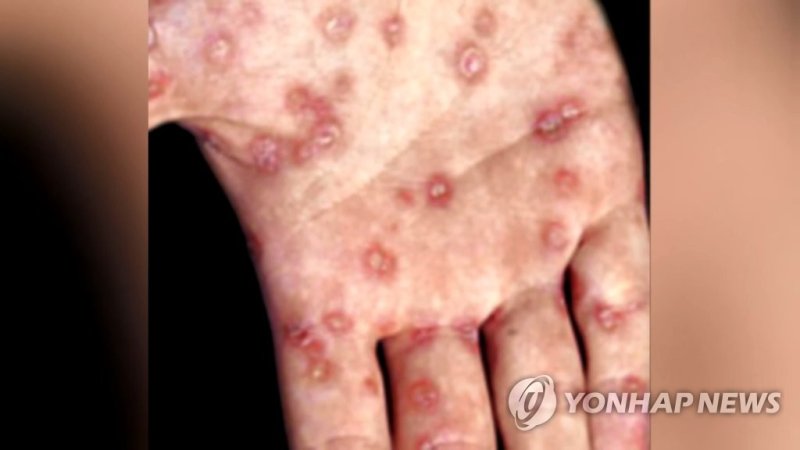 작년에도 역시…매독 환자 2790명 중 '2030·남성'이 과반