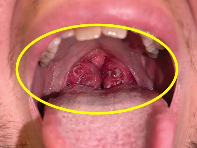 '키스병' 뭐길래…"여자 친구 만나고 편도가" [헬스톡]