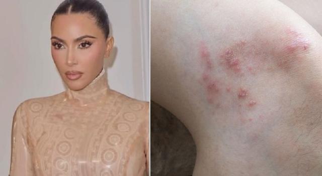 킴 카다시안 "고통스럽다" 호소한 이 병..부자일수록 더 잘 걸린다? [헬스톡]